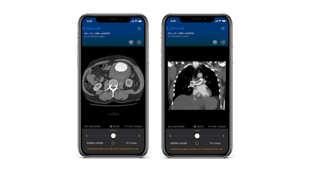 New clinical data support AI solution for improved PE detection and care coordination