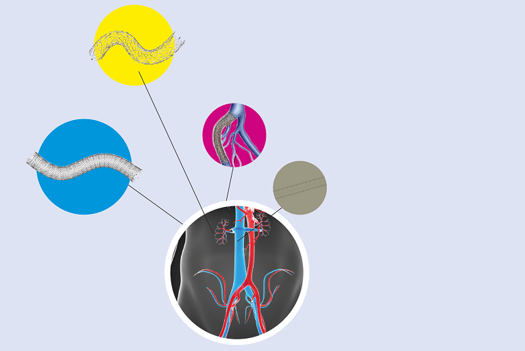 Study highlights declining venous stent patency rates after one year
