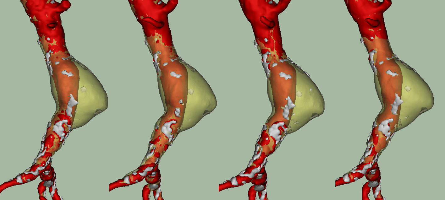 Endovascular stablization system for infrarenal AAAs gains FDA Fast Track designation