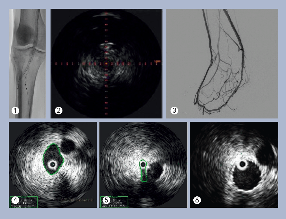 Use of IVUS reduces patient risk of MALE or death by up to 28%: Data support consensus views on importance of advanced visualization for peripheral vascular disease interventions