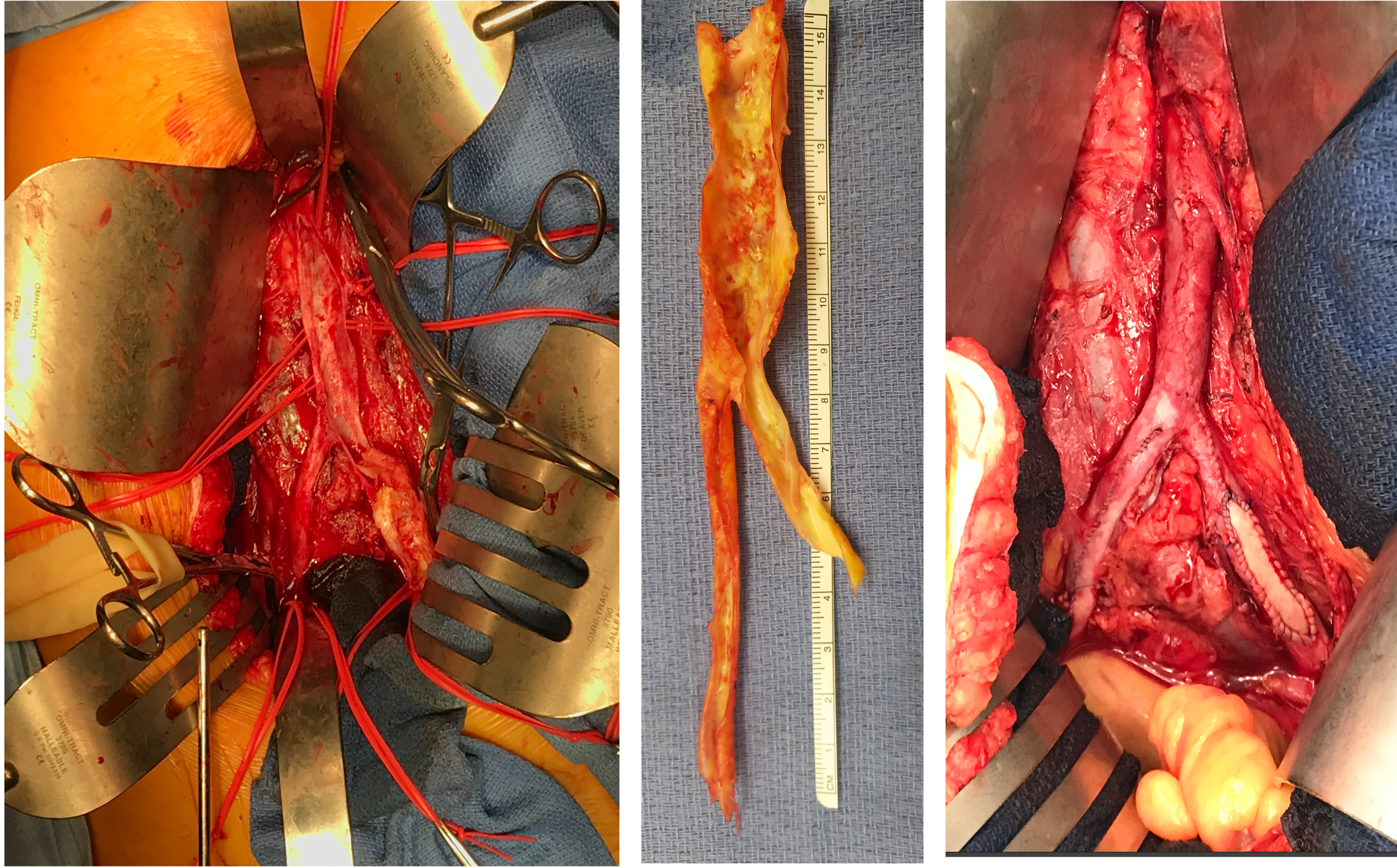 Re-evaluating aortoiliac endarterectomy: Case series shows ‘acceptable durability’