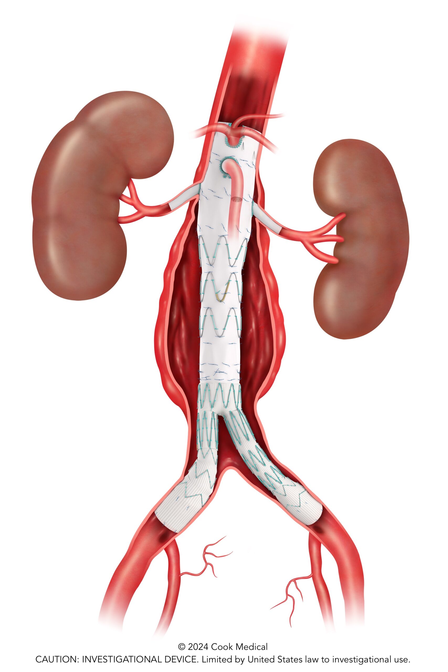 First patient treated in ZFEN+ fenestrated endovascular graft study