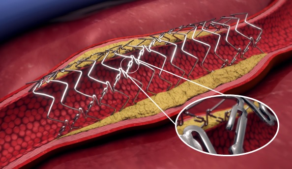 FDA Breakthrough Device designation granted for DynamX BTK for use in CLTI treatment below the knee