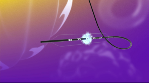 FastWave Medical announces successful 30-day first-in-human data on peripheral IVL technology