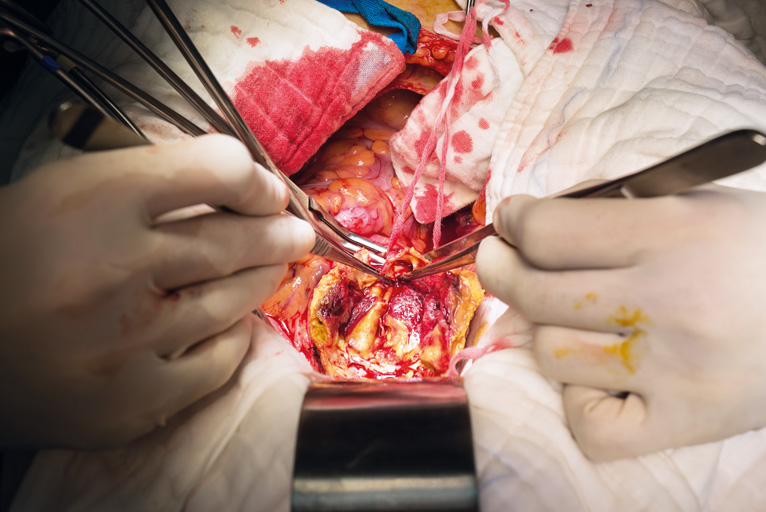 Perioperative care in open aortic vascular surgery: join upcoming webinar