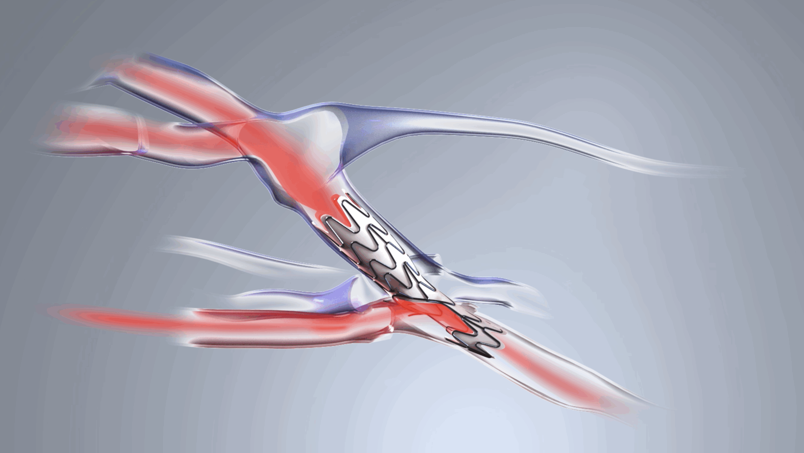 Early feasibility study for Velocity pAVF system now fully enrolled