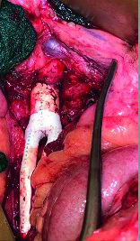 Long-term VQI-VISION analysis sheds light on PVI versus bypass in aortoiliac occlusive disease