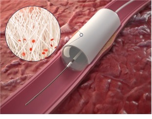 StentIt launches first-in-human trial of bioresorbable stent to treat below-the-knee CLTI