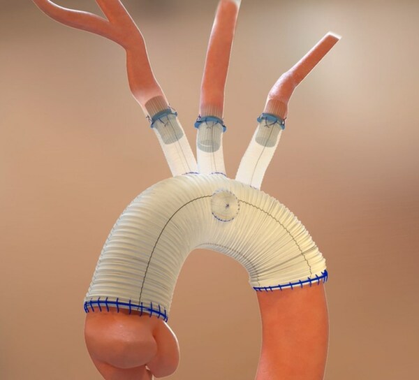 Aquedeon Medical receives FDA approval to expand clinical trial of Duett vascular graft system