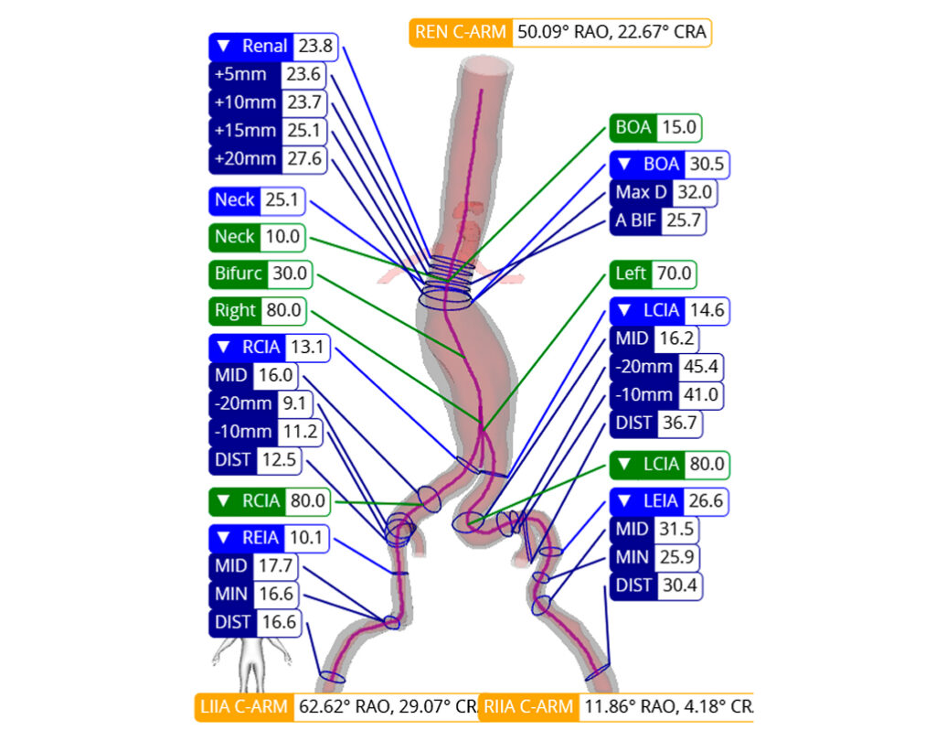 ViTAA Medical announces FDA 510(k) clearance for aortic planning platform