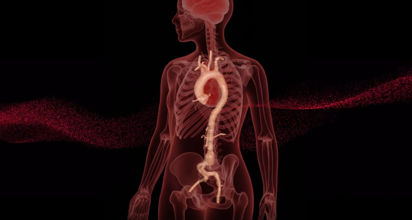 RapidAI earns US FDA clearance for AI-driven aortic measurement and surveillance product